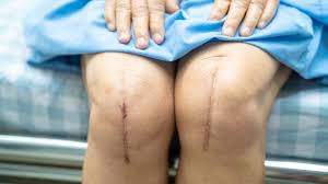 Post Knee replacement surgery